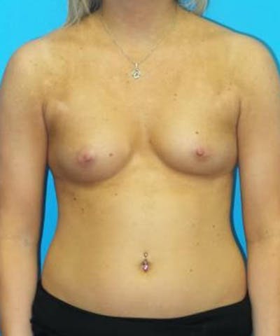 Breast Augmentation Before & After Gallery - Patient 276518 - Image 1