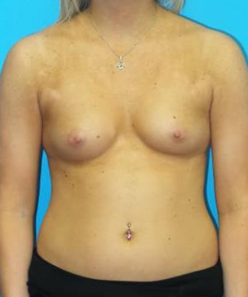 Breast Augmentation Before & After Gallery - Patient 276518 - Image 1