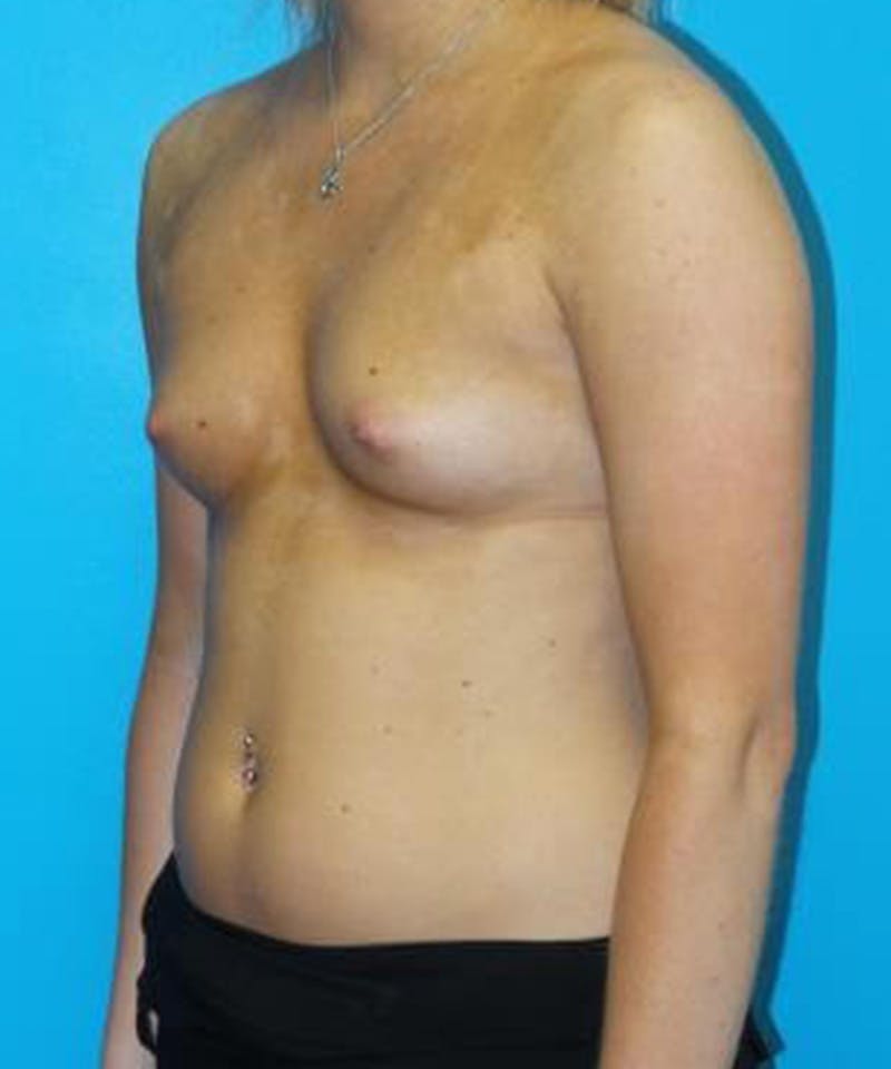Breast Augmentation Before & After Gallery - Patient 276518 - Image 3