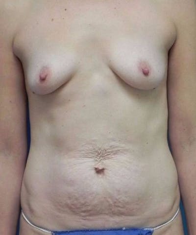 Breast Augmentation Before & After Gallery - Patient 342564 - Image 1