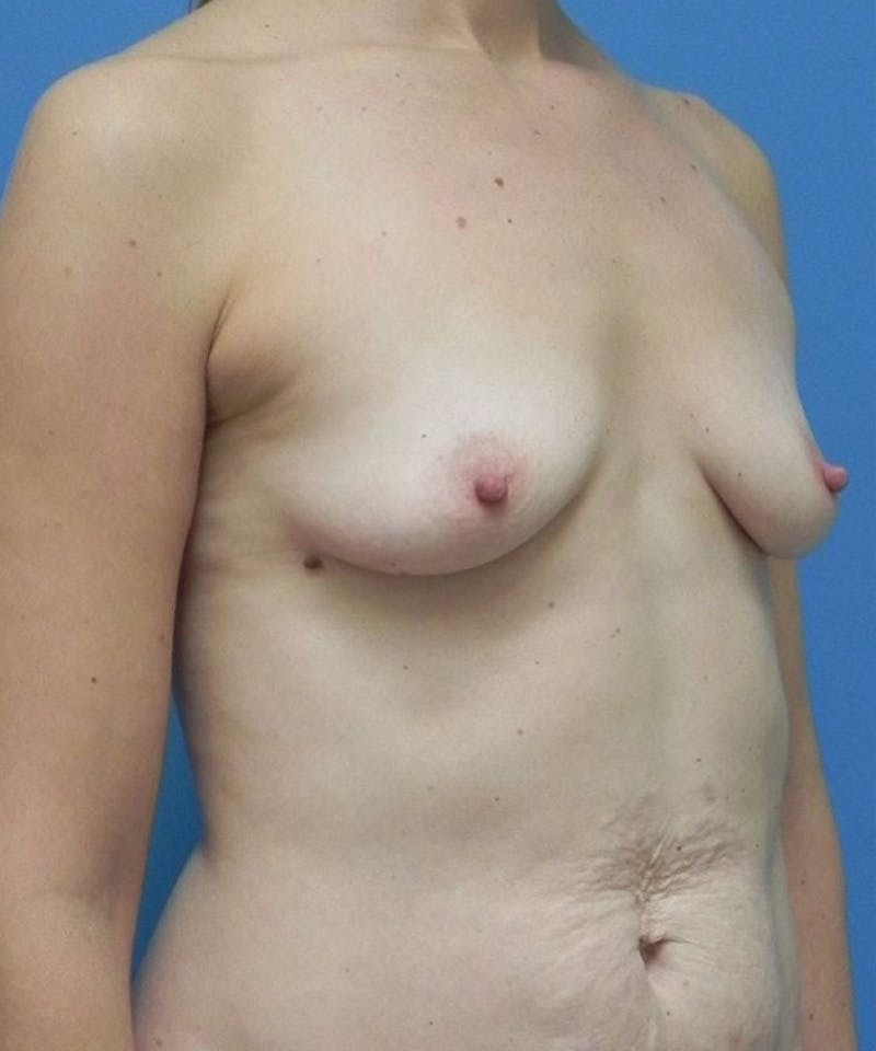 Breast Augmentation Before & After Gallery - Patient 342564 - Image 3