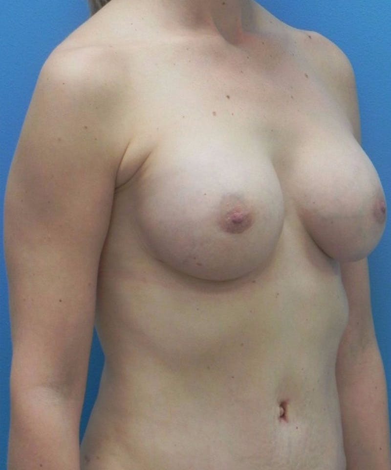Breast Augmentation Before & After Gallery - Patient 342564 - Image 4