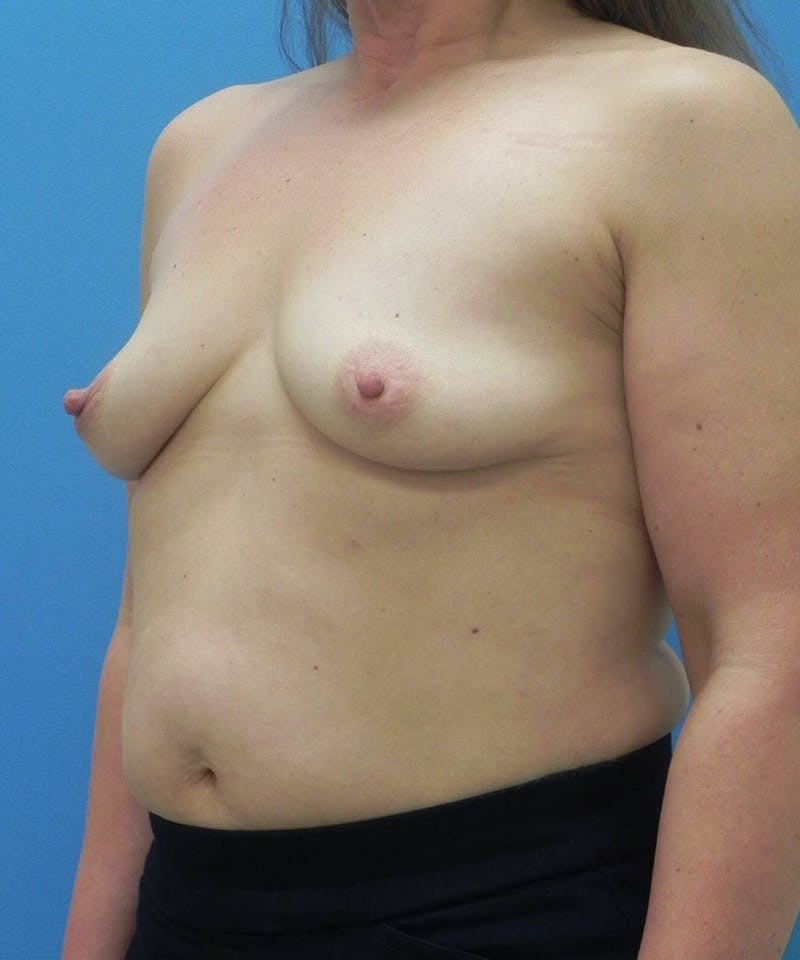 Breast Augmentation Before & After Gallery - Patient 226833 - Image 3