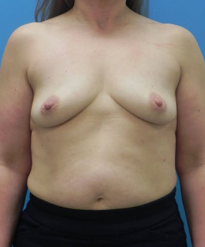 Breast Augmentation Before & After Gallery - Patient 226833 - Image 1