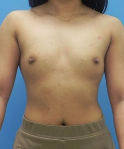 Breast Augmentation Before & After Gallery - Patient 292188 - Image 1