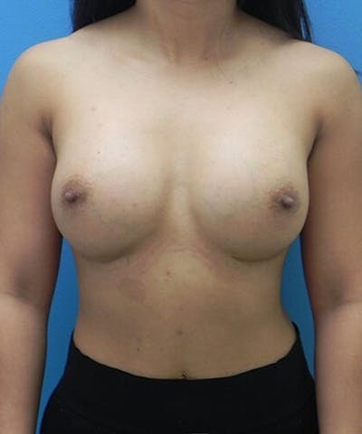 Breast Augmentation Before & After Gallery - Patient 292188 - Image 2