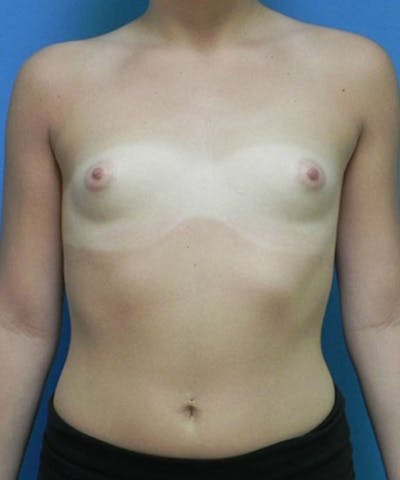 Breast Augmentation Before & After Gallery - Patient 400138 - Image 1