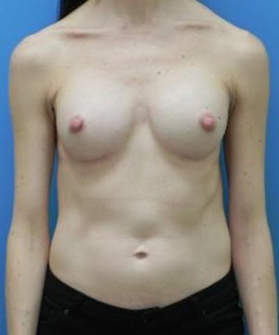 Breast Augmentation Before & After Gallery - Patient 282516 - Image 2