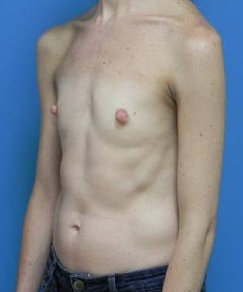 Breast Augmentation Before & After Gallery - Patient 282516 - Image 3