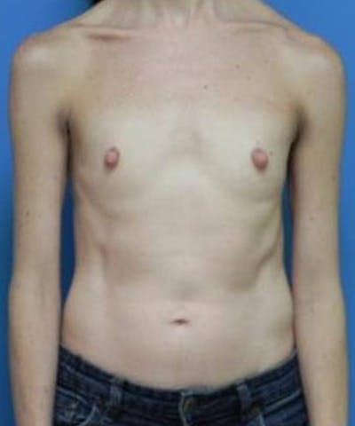 Breast Augmentation Before & After Gallery - Patient 282516 - Image 1