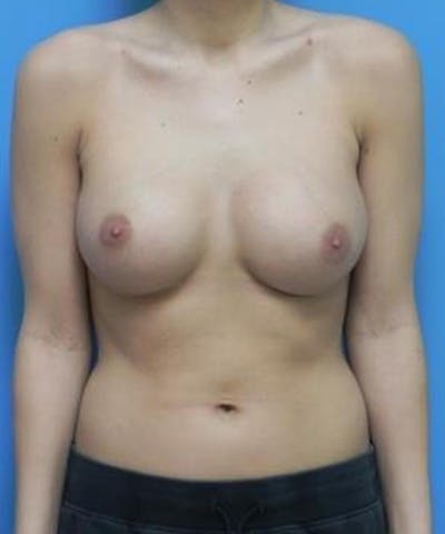 Breast Augmentation Before & After Gallery - Patient 355042 - Image 2
