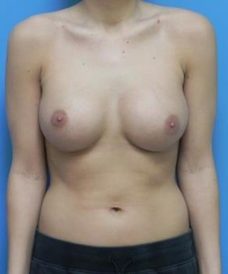 Breast Augmentation Before & After Gallery - Patient 355042 - Image 2