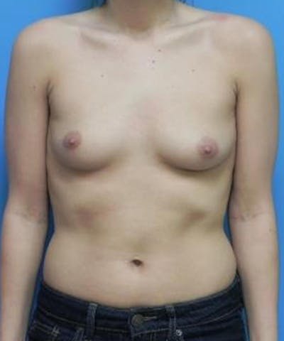 Breast Augmentation Before & After Gallery - Patient 355042 - Image 1