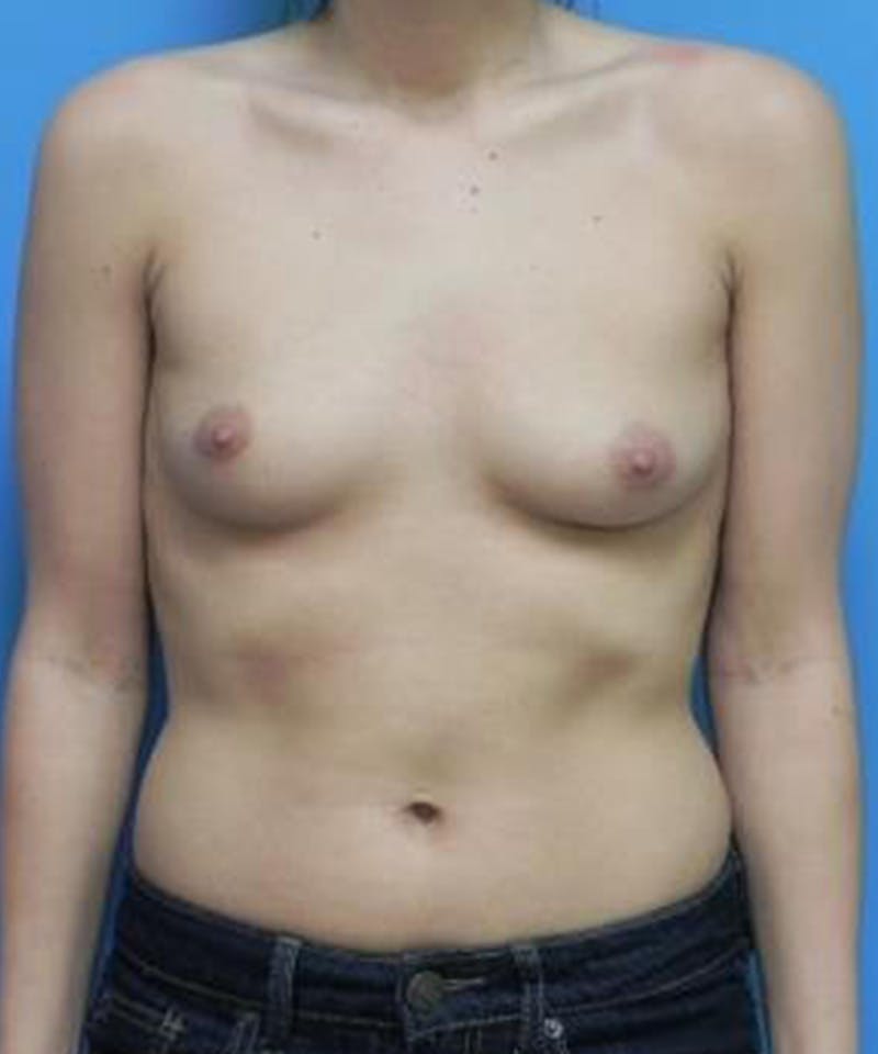 Breast Augmentation Before & After Gallery - Patient 355042 - Image 1