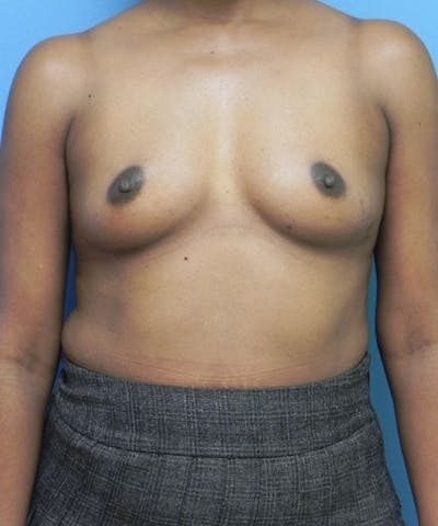 Breast Augmentation Before & After Gallery - Patient 463771 - Image 1