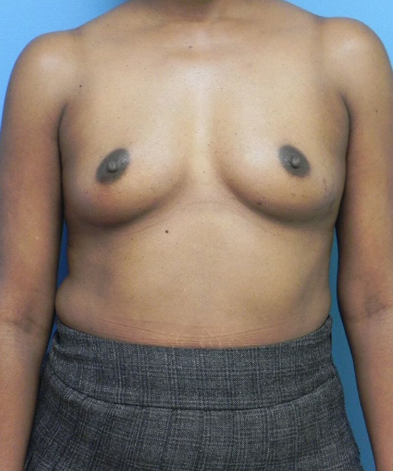 Breast Augmentation Before & After Gallery - Patient 463771 - Image 1