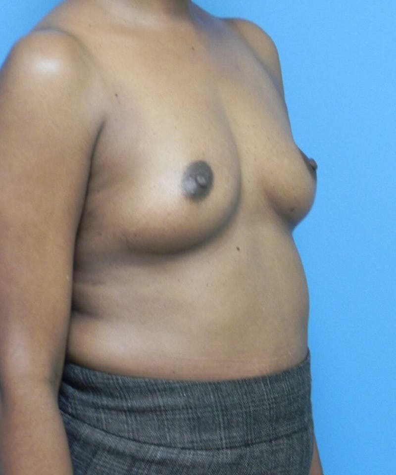 Breast Augmentation Before & After Gallery - Patient 463771 - Image 3