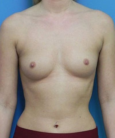 Breast Augmentation Before & After Gallery - Patient 109094 - Image 1