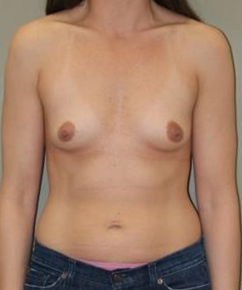 Breast Augmentation Before & After Gallery - Patient 390215 - Image 1