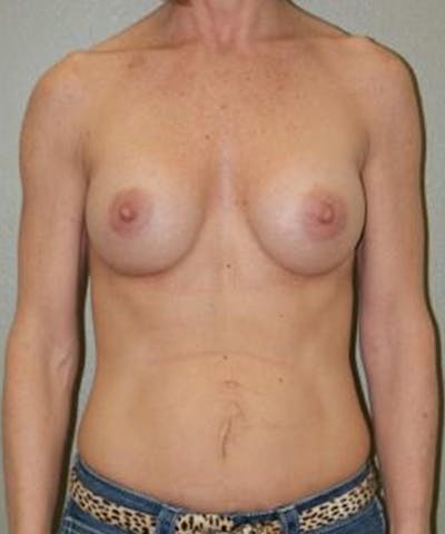 Breast Augmentation Before & After Gallery - Patient 308024 - Image 2