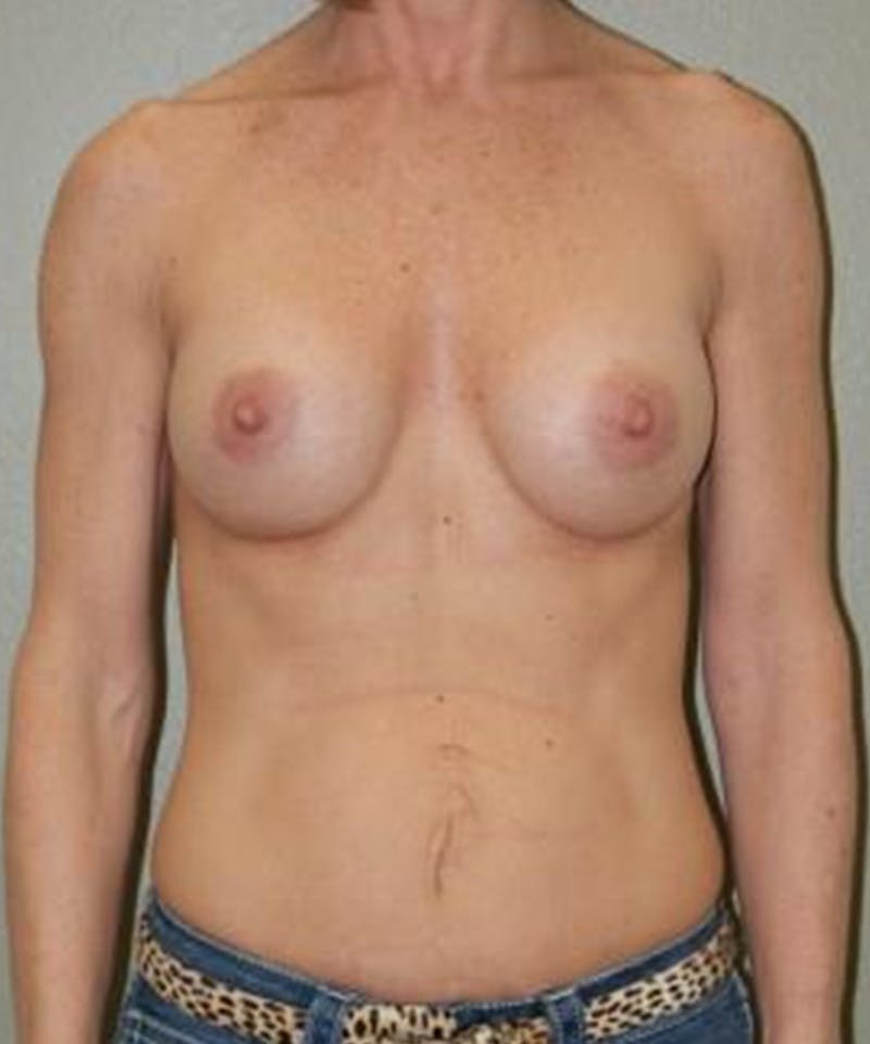 Breast Augmentation Before & After Gallery - Patient 308024 - Image 2