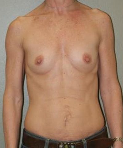 Breast Augmentation Before & After Gallery - Patient 308024 - Image 1