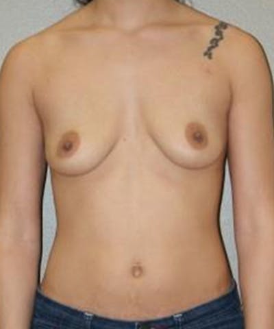 Breast Augmentation Before & After Gallery - Patient 220557 - Image 1