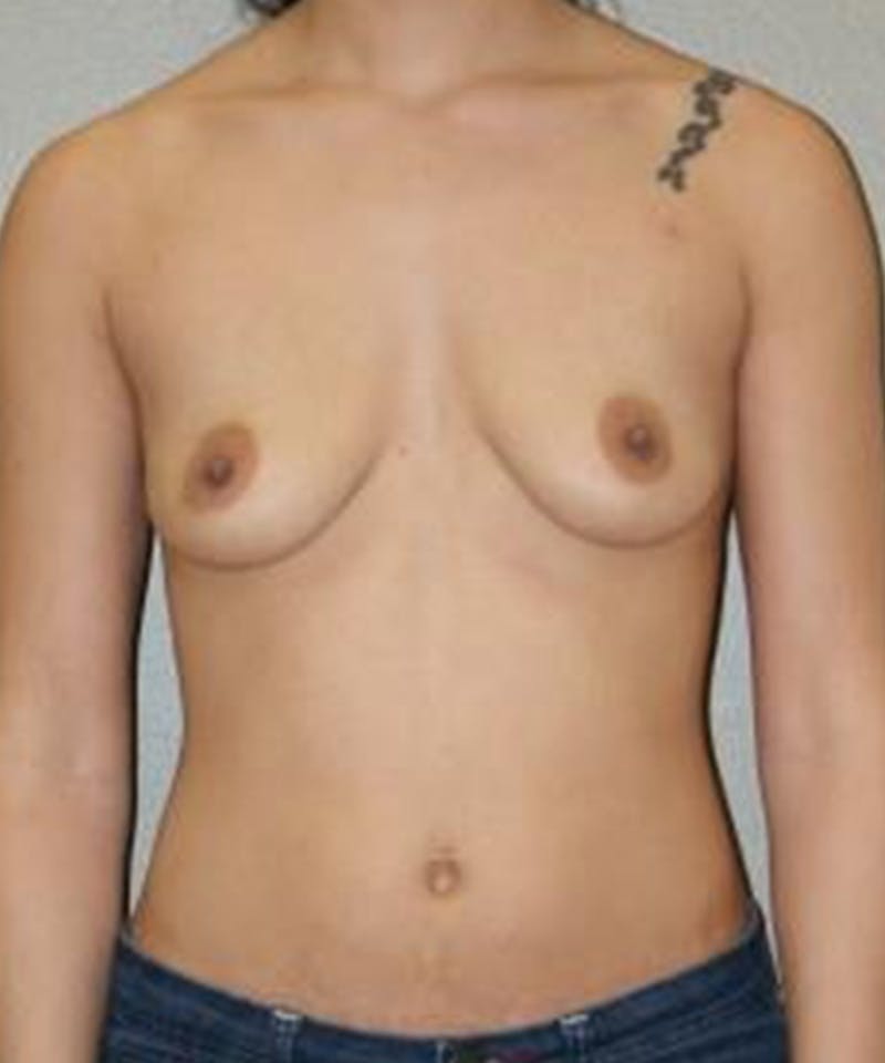 Breast Augmentation Before & After Gallery - Patient 220557 - Image 1