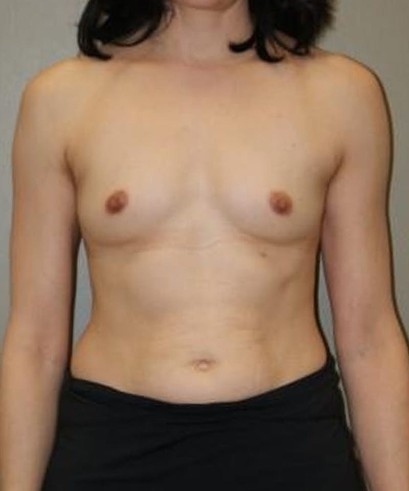 Breast Augmentation Before & After Gallery - Patient 188386 - Image 1
