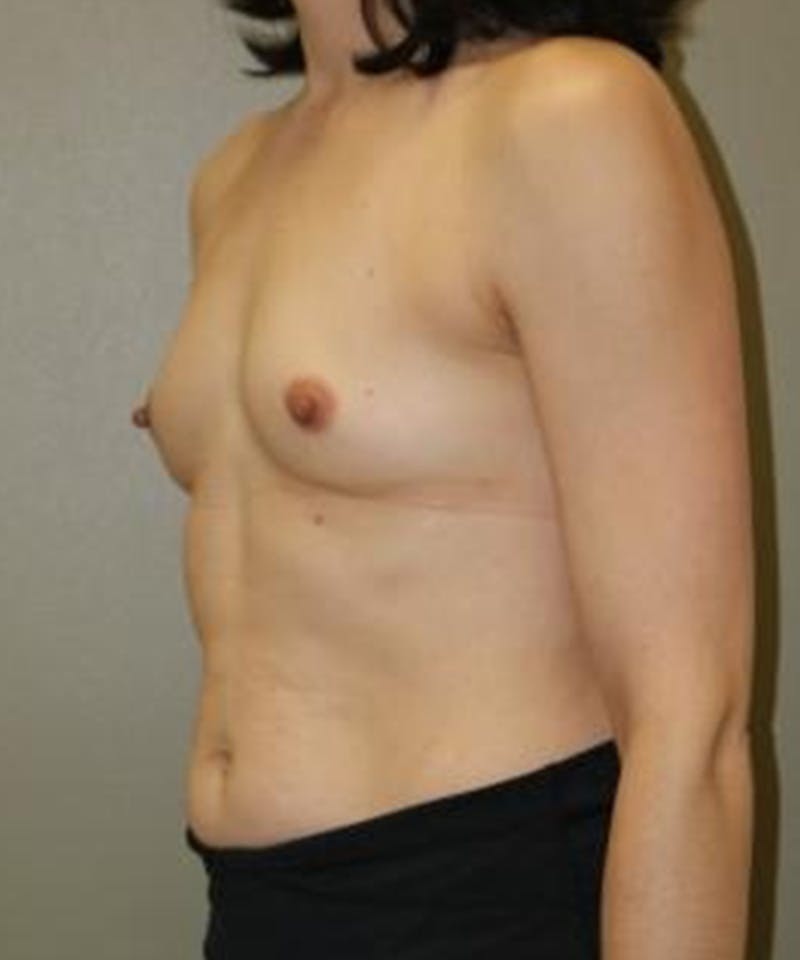 Breast Augmentation Before & After Gallery - Patient 188386 - Image 3