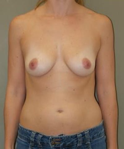 Breast Augmentation Before & After Gallery - Patient 330001 - Image 1