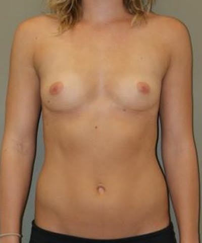 Breast Augmentation Before & After Gallery - Patient 290976 - Image 1
