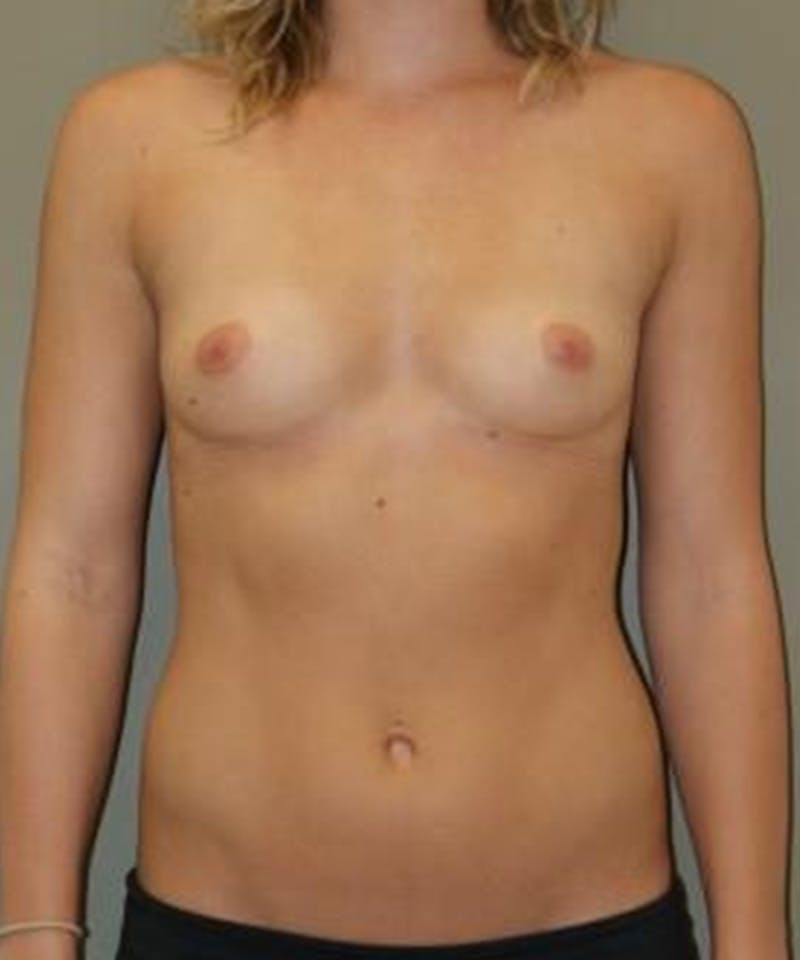 Breast Augmentation Before & After Gallery - Patient 290976 - Image 1