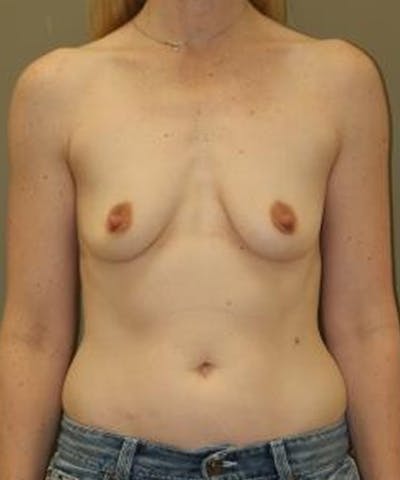 Breast Augmentation Before & After Gallery - Patient 495147 - Image 1