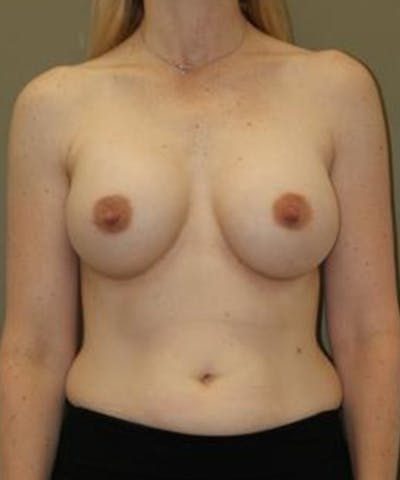 Breast Augmentation Before & After Gallery - Patient 495147 - Image 2