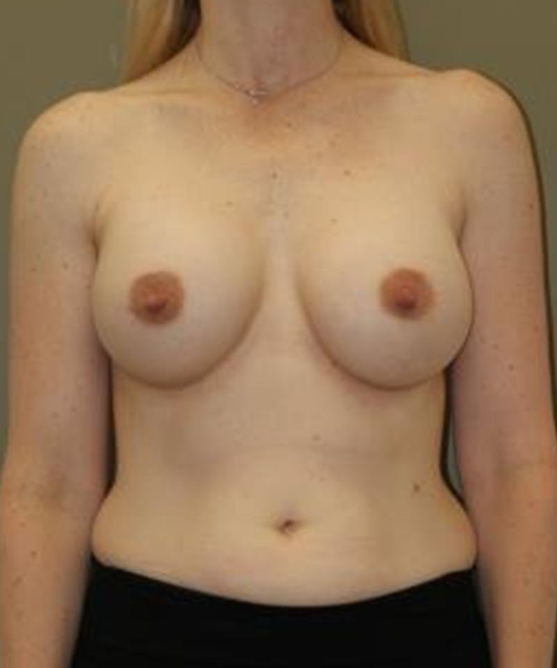Breast Augmentation Before & After Gallery - Patient 495147 - Image 2