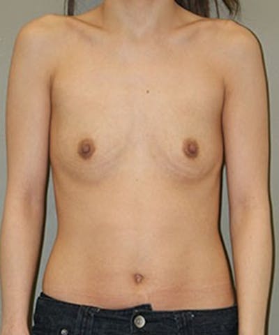 Breast Augmentation Before & After Gallery - Patient 103777 - Image 1