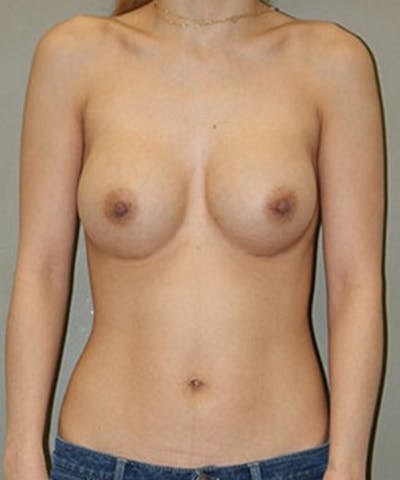 Breast Augmentation Before & After Gallery - Patient 103777 - Image 2
