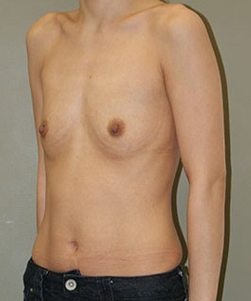 Breast Augmentation Before & After Gallery - Patient 103777 - Image 3