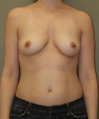 Breast Augmentation Before & After Gallery - Patient 382523 - Image 1