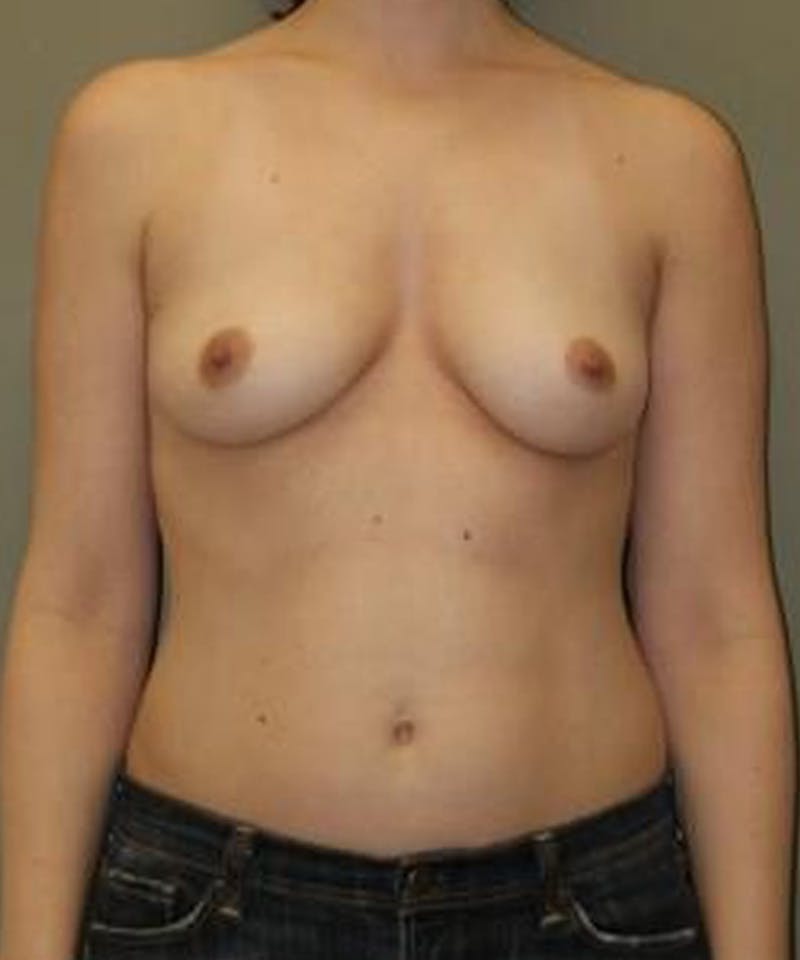 Breast Augmentation Before & After Gallery - Patient 382523 - Image 1