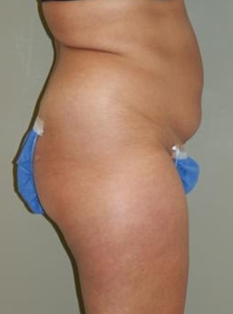 Liposuction Before & After Gallery - Patient 397642 - Image 3
