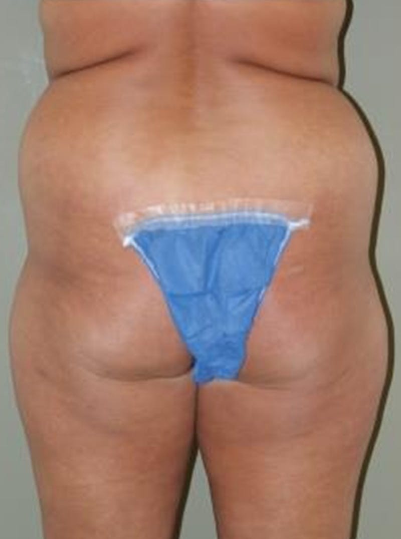 Liposuction Before & After Gallery - Patient 397642 - Image 5