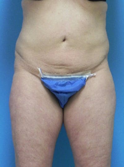 Liposuction Before & After Gallery - Patient 397642 - Image 1