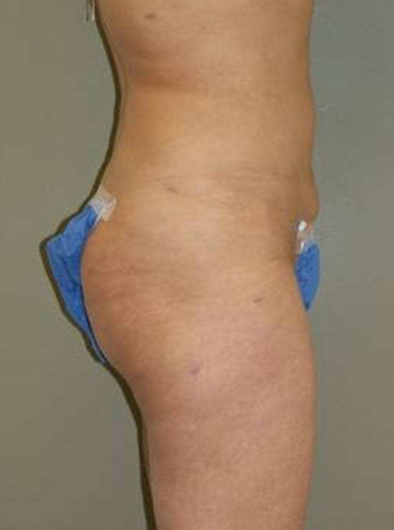 Liposuction Before & After Gallery - Patient 397642 - Image 4