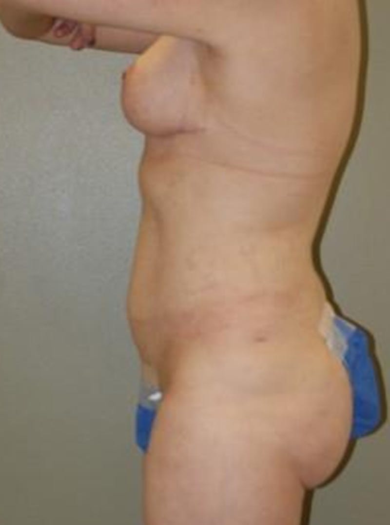 Liposuction Before & After Gallery - Patient 739698 - Image 6