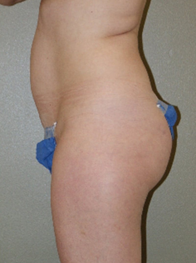 Liposuction Before & After Gallery - Patient 290213 - Image 3