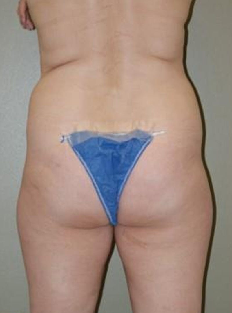 Liposuction Before & After Gallery - Patient 290213 - Image 5