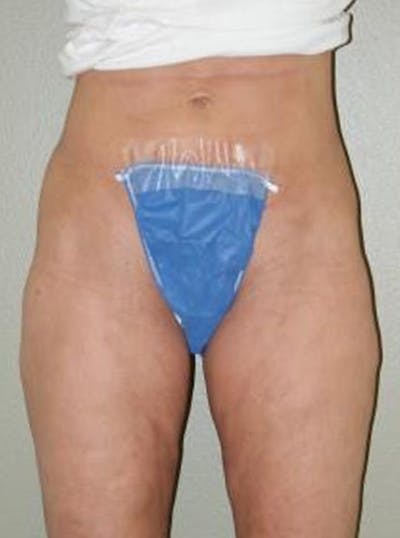Liposuction Before & After Gallery - Patient 262222 - Image 2