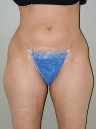 Liposuction Before & After Gallery - Patient 262222 - Image 1